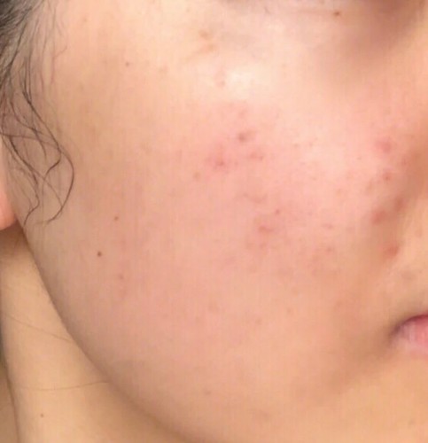 益膚醫(yī)用冷敷貼面膜怎么樣好不好，真實使用體驗(敏感肌必備)